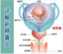 邢台精囊炎的诊断依据是什么呢?