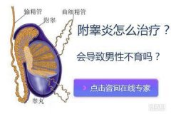 邢台附睾炎治疗?