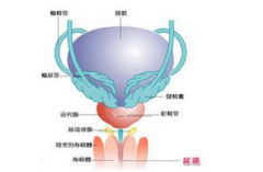 邢台男性精囊炎是怎么引起