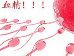 邢台血精症的治疗方法
