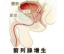 邢台前列腺囊肿患者如何进行日常保健