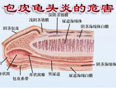 邢台龟头炎的危害来自5个方面