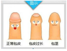 邢台包皮过长疾病的相关症状有哪些