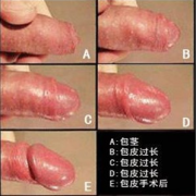邢台泌尿医院:包皮过长有什么好处