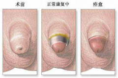 邢台包皮过长手术需要多少钱呢