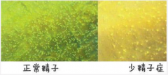 邢台诱发少精症的因素有哪些