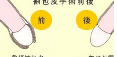 邢台包皮过长为什么影响性生活