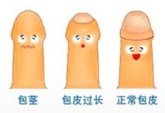 韩式包皮环切