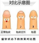 包皮过长