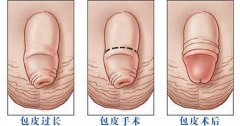 邢台包皮手术多久可以运动