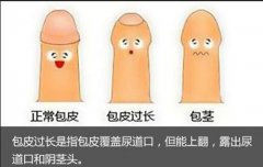 什么是包皮与包茎